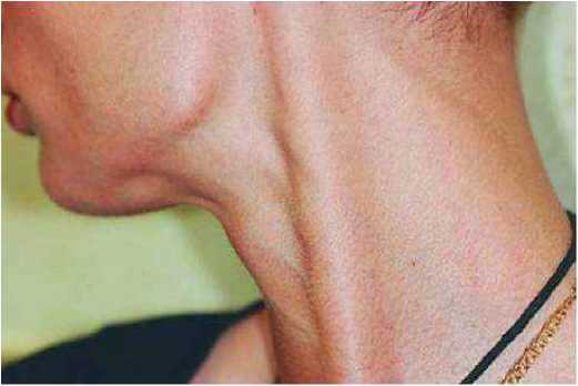 Гипертонус жевательных мышц и его коррекция БТА при эстетических проблемах нижней половины лица