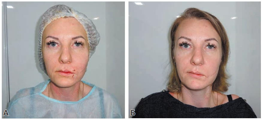 Малоинвазивные методы коррекции асимметрии лица при парезе лицевого нерва