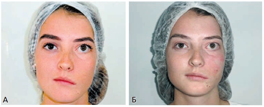 Малоинвазивные методы коррекции асимметрии лица при парезе лицевого нерва
